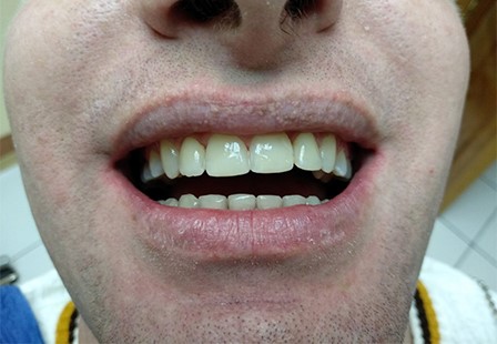 брекеты Николаев