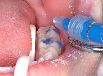 Герметизация фиссур, ДентаЛюкс