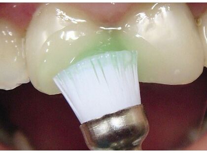 Эмалевая микроабразия, ДентаЛюкс