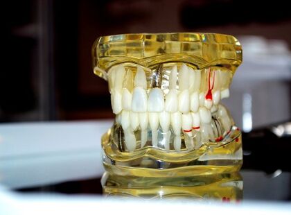 Протезирование зубов