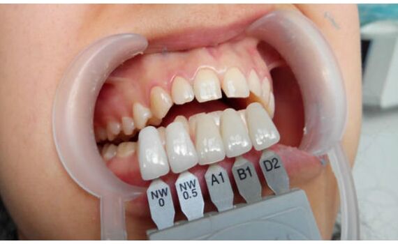 Виниры в Николаеве