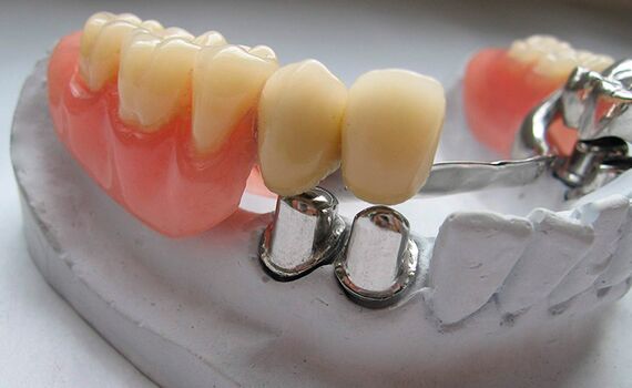 бюгельный протез Николаев