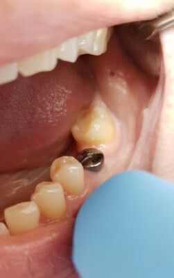 Формирователь десны перед имплантацией