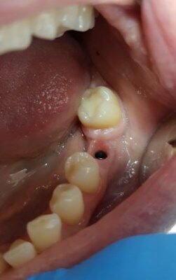 Подготовка к имплантации зуба