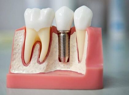 Имплантация зубов в Николаеве