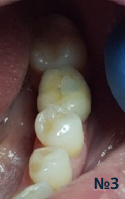 Результат установки импланта в полость рта