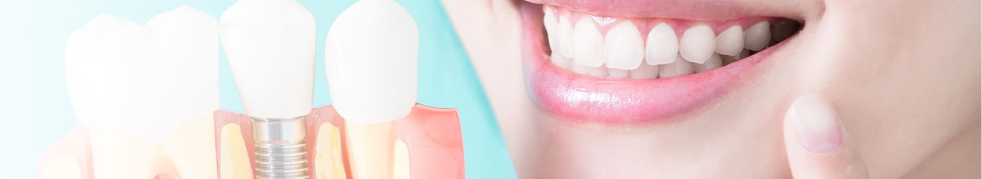 зубные импланты, Николаев