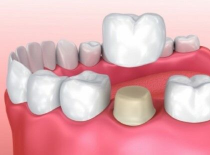 Коронка на зуб