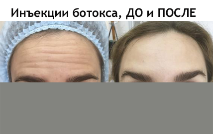 Инъекции ботокса