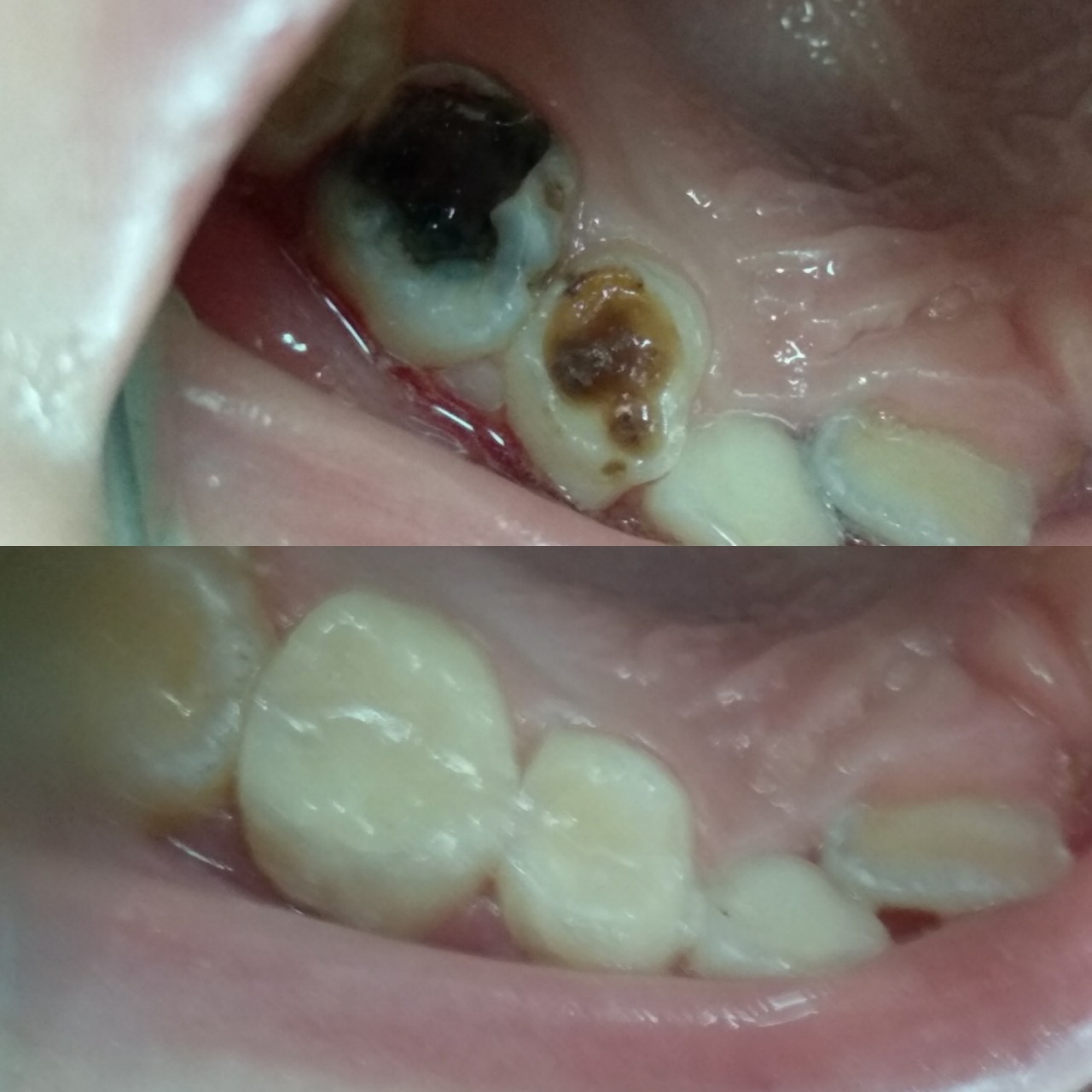 лечение зубов у детей