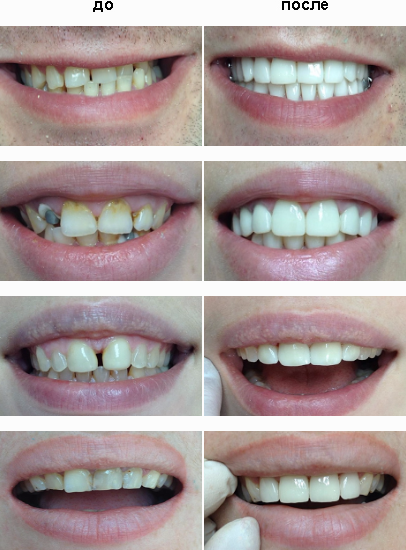 Реставрация зубов в Николаеве