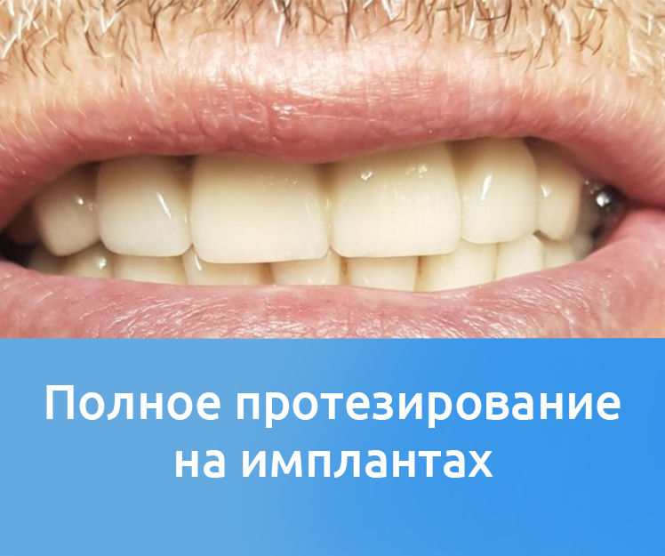 Результат полного протезирования на имплантах - Николаев, Денталюкс