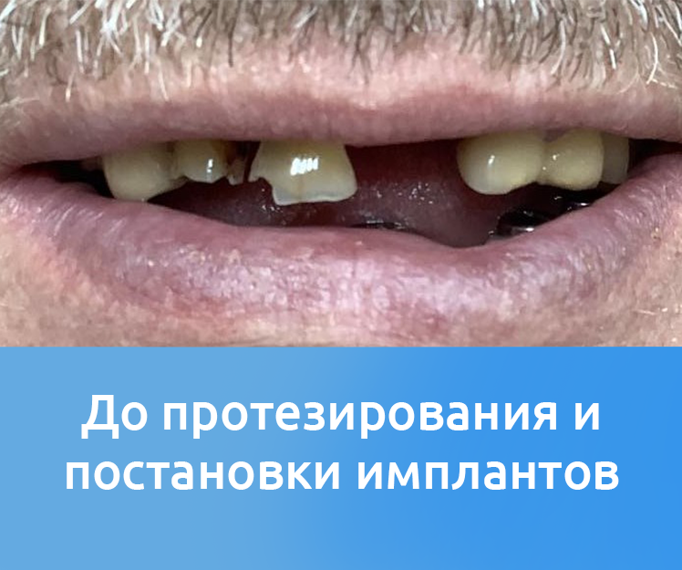 Состояние ротовой полости до имплантации зубов