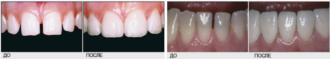 Виниры без обточки зубов (люминиры)