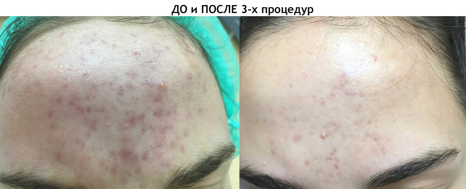 Плазмолифтинг лица