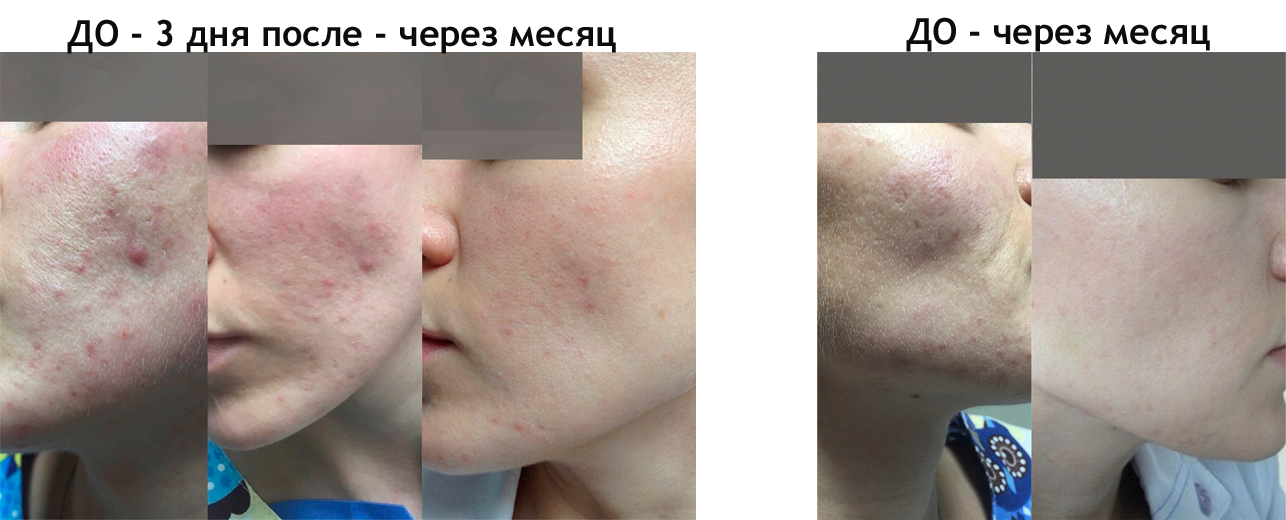 Процедура плазмолифтинга лица в Николаеве