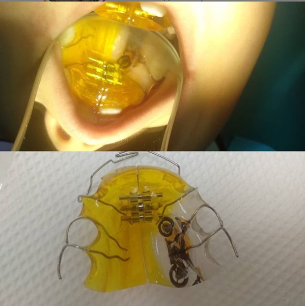 Ортодонтическая пластина