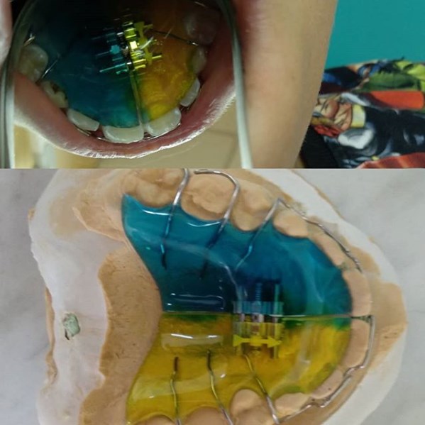 Ортодонтическая пластина